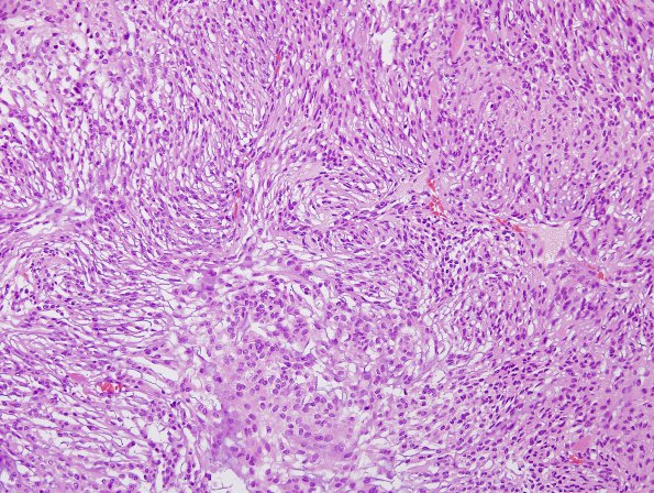 12B1 Meningioma, chordoid (Case 12) H&E 3