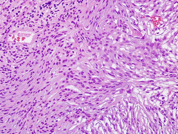 12B2 Meningioma, chordoid (Case 12) H&E 1