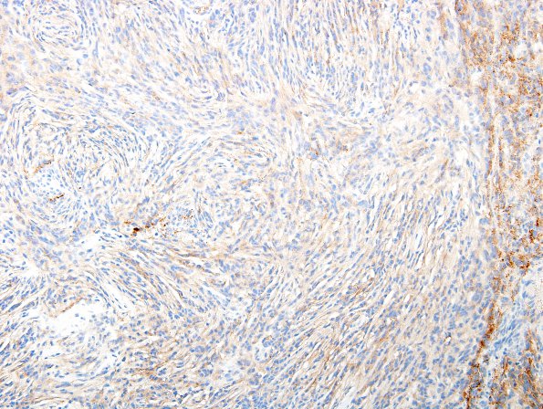 12C Meningioma, chordoid (Case 12) EMA 2