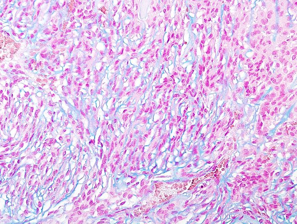 12D1 Meningioma, chordoid (Case 12) Alcian Blue 1