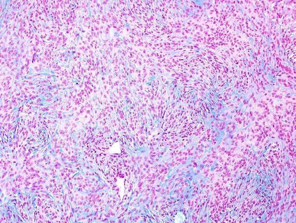 12D2 Meningioma, chordoid (Case 12) Alcian Blue 4