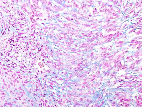 12D3 Meningioma, chordoid (Case 12 Alcian Blue 3