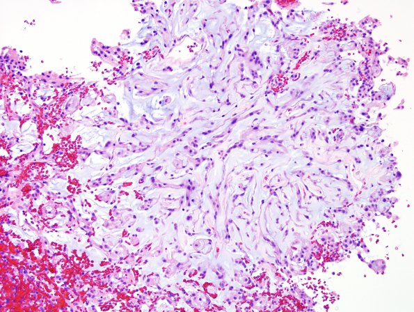 13A1 Meningioma, chordoid (Case 13) H&E 2