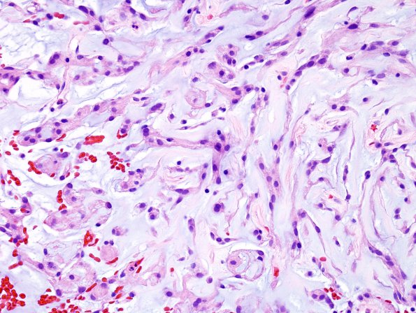 13A2 Meningioma, chordoid (Case 13) H&E 1