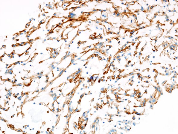 13B Meningioma, chordoid (Case 13) EMA 2