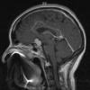 14A1 Meningioma, chordoid (Case 14) T1-post contrast 2 - Copy