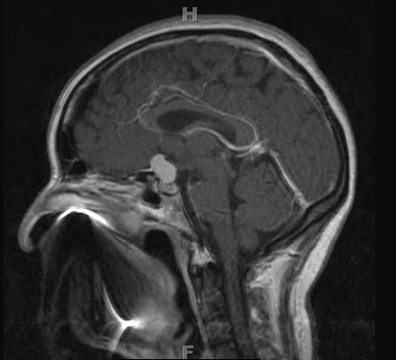 14A1 Meningioma, chordoid (Case 14) T1-post contrast 2 - Copy