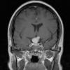 14A2 Meningioma, chordoid (Case 14) T1-post contrast 5 - Copy