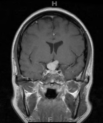 14A2 Meningioma, chordoid (Case 14) T1-post contrast 5 - Copy