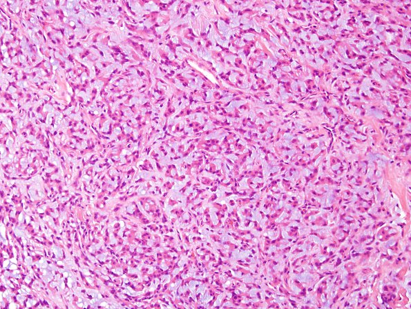 14B1 Meningioma, chordoid (Case 14) H&E 16