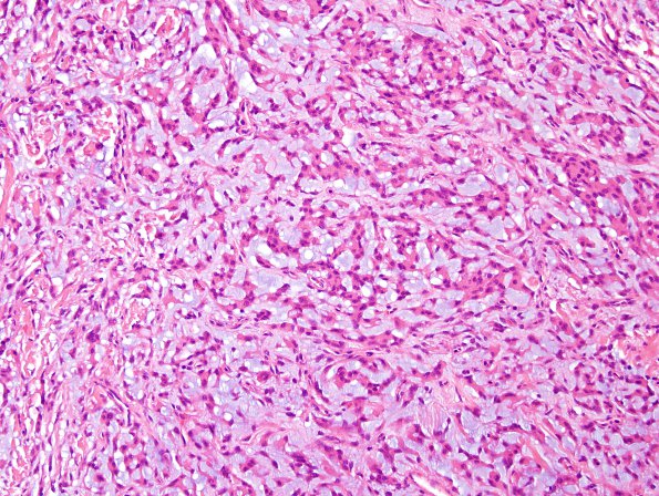 14B2 Meningioma, chordoid (Case 14) H&E 11