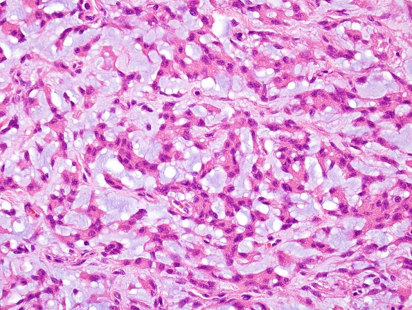 14B3 Meningioma, chordoid (Case 14) H&E 15