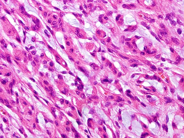 14B4 Meningioma, chordoid (Case 14) H&E-1