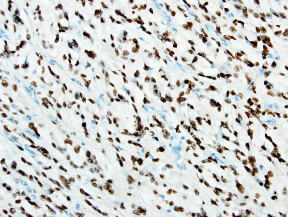 14C1 Meningioma, chordoid (Case 14) PR-1