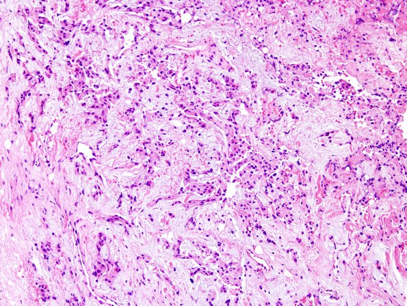 15A Meningioma, chordoid (Case 15) H&E 6.jpg