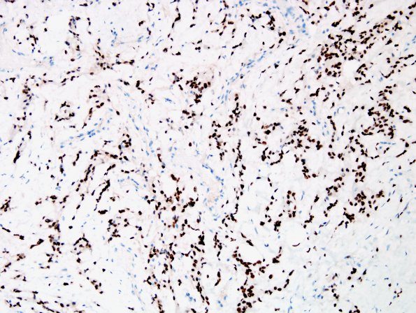 15B Meningioma, chordoid (Case 15) PR 1.jpg