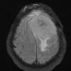 1A1 New series Meningioma, anaplastic, chordoid (Case 1) FLAIR 1 - Copy