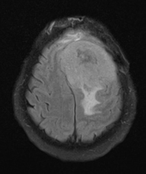 1A1 New series Meningioma, anaplastic, chordoid (Case 1) FLAIR 1 - Copy