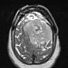 1A2 New series Meningioma, anaplastic, chordoid (Case 1) T2W - Copy