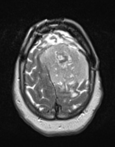 1A2 New series Meningioma, anaplastic, chordoid (Case 1) T2W - Copy