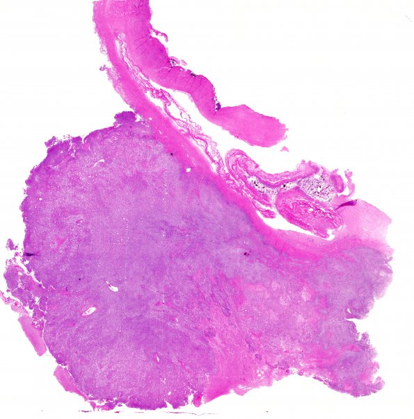 1B1 Meningioma, anaplastic, chordoid (Case 1) H&E whole mount 2