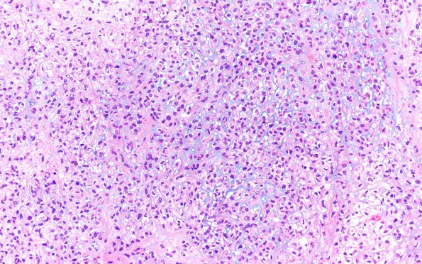 1B2 Meningioma, anaplastic, chordoid (Case 1) A14 H&E chordoid area 20X