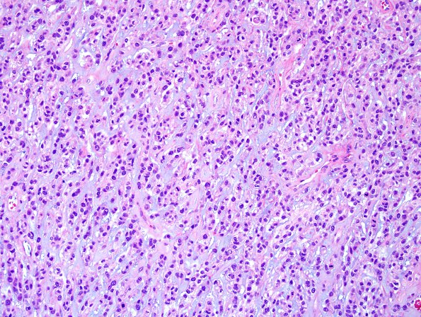 1B2 Meningioma, anaplastic, chordoid (Case 1) H&E 4.jpg