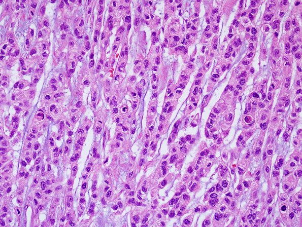 1B4 Meningioma, anaplastic, chordoid (Case 1) H&E 2.jpg