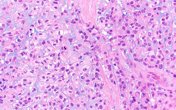 1B5 Meningioma, anaplastic, chordoid (Case 1) A14 H&E chordoid area & mitoses 40X