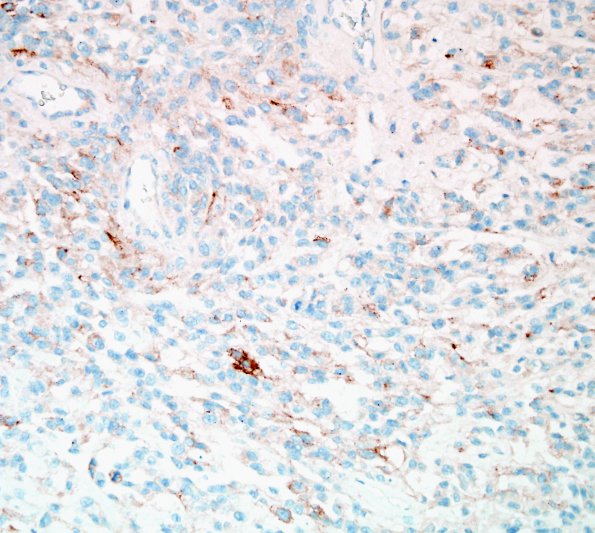 1D Meningioma, anaplastic, chordoid (Case 1) EMA 5.jpg