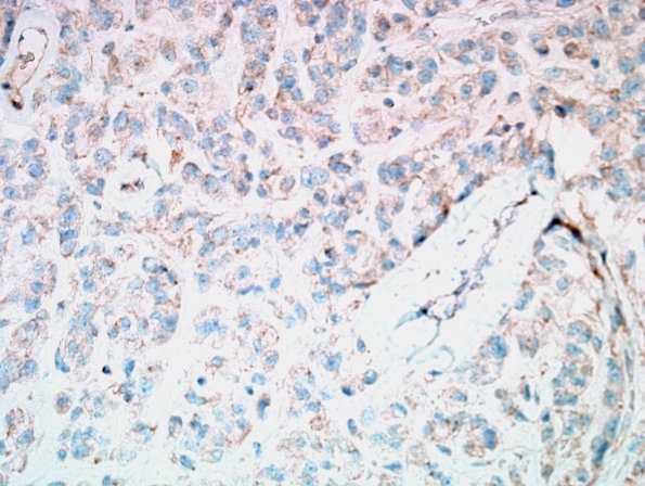 1E Meningioma, anaplastic, chordoid (Case 1) Brachyury 1.jpg