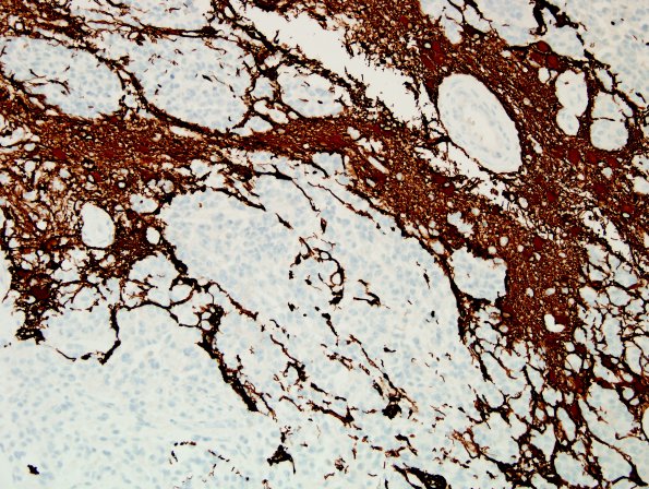 1F2 Meningioma, anaplastic, chordoid (Case 1) GFAP 2.jpg