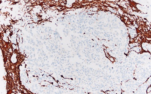 1F3 Meningioma, anaplastic, chordoid (Case 1) A8 GFAP 20X