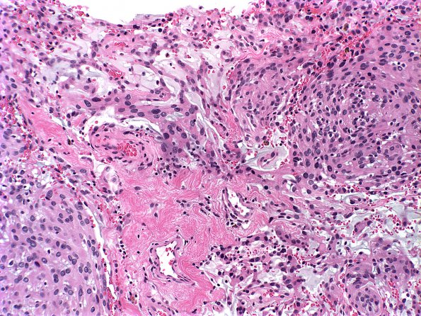 2A1 Meningioma, Choroid (Case 2) d