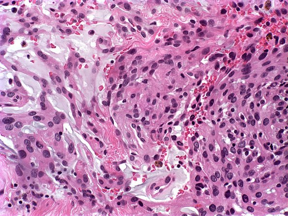 2A2 Meningioma, Chordoid part (Case 2) c