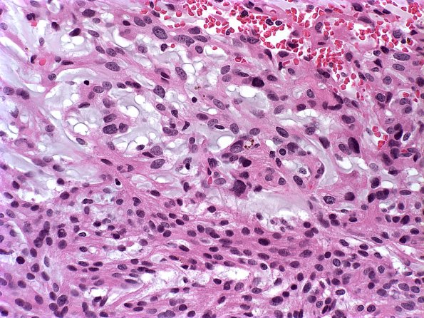 2A3 Meningioma, Chordoid (Case 2) a