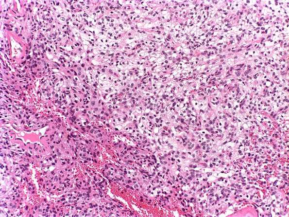 2A4 Meningioma, Clear cell part (Case 2) b