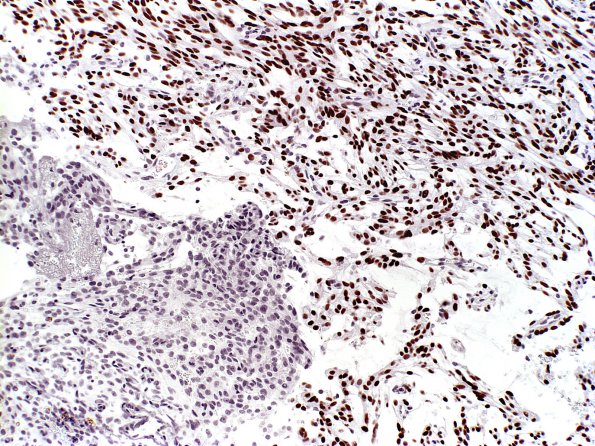 2B Meningioma, (Case 2) PR a