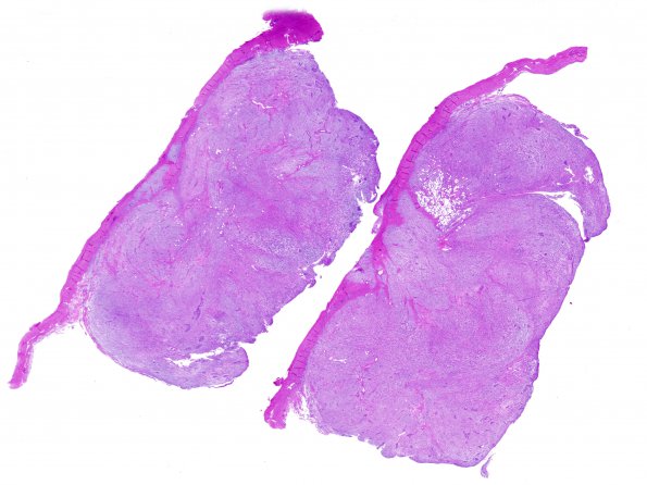 3A1 Meningioma, Chordoid (Case 3) 2