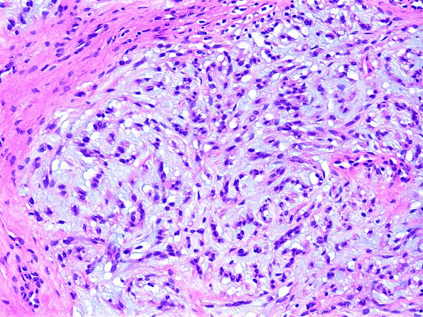 3A2 Meningioma, Chordoid (Case 3) 1