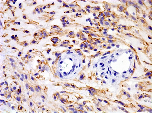 3B Meningioma, Chordoid (Case 3) EMA