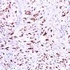 3C Meningioma, Chordoid (Case 3) PR