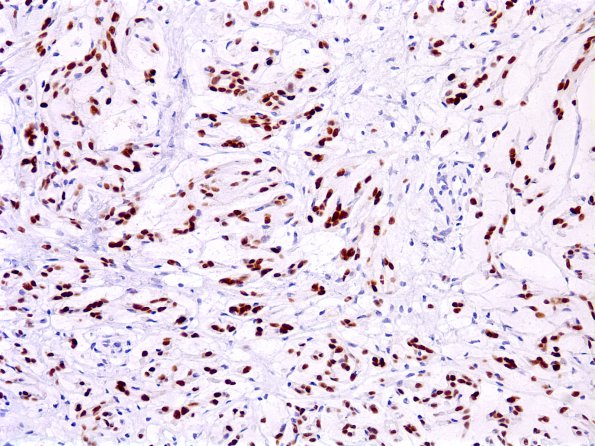 3C Meningioma, Chordoid (Case 3) PR