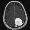 4A1Meningioma, chordoid (Case 4) T1 W 1 - Copy