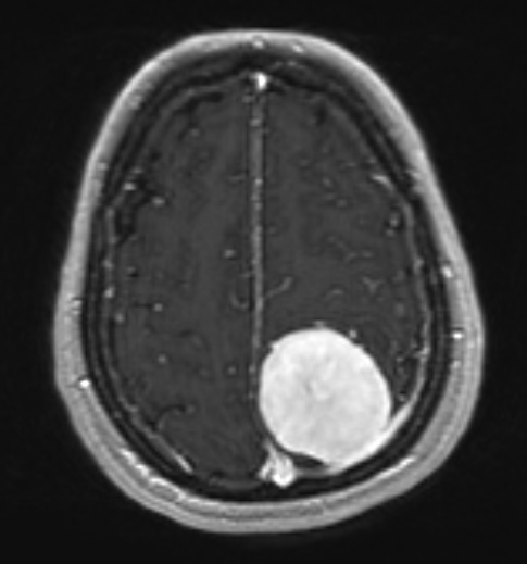 4A1Meningioma, chordoid (Case 4) T1 W 1 - Copy