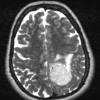 4A2 Meningioma, chordoid (Case 4) T2 - Copy