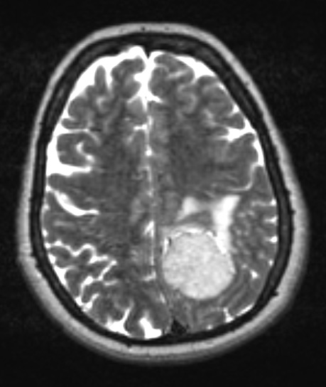 4A2 Meningioma, chordoid (Case 4) T2 - Copy