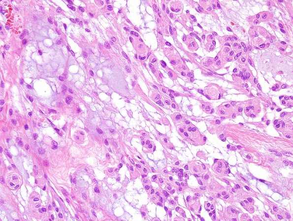 4B1 Meningioma, chordoid (Case 4) H&E 1.jpg