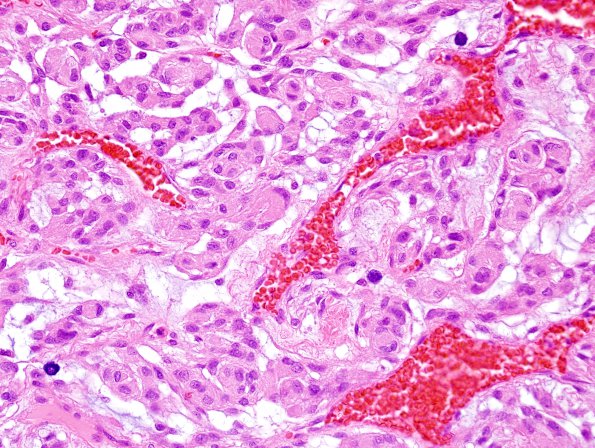 4B2 Meningioma, chordoid (Case 4) H&E 3.jpg