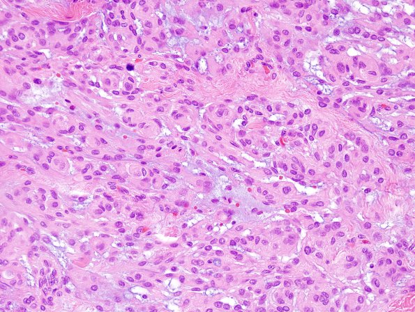 4B3 Meningioma, chordoid (Case 4) H&E 4.jpg